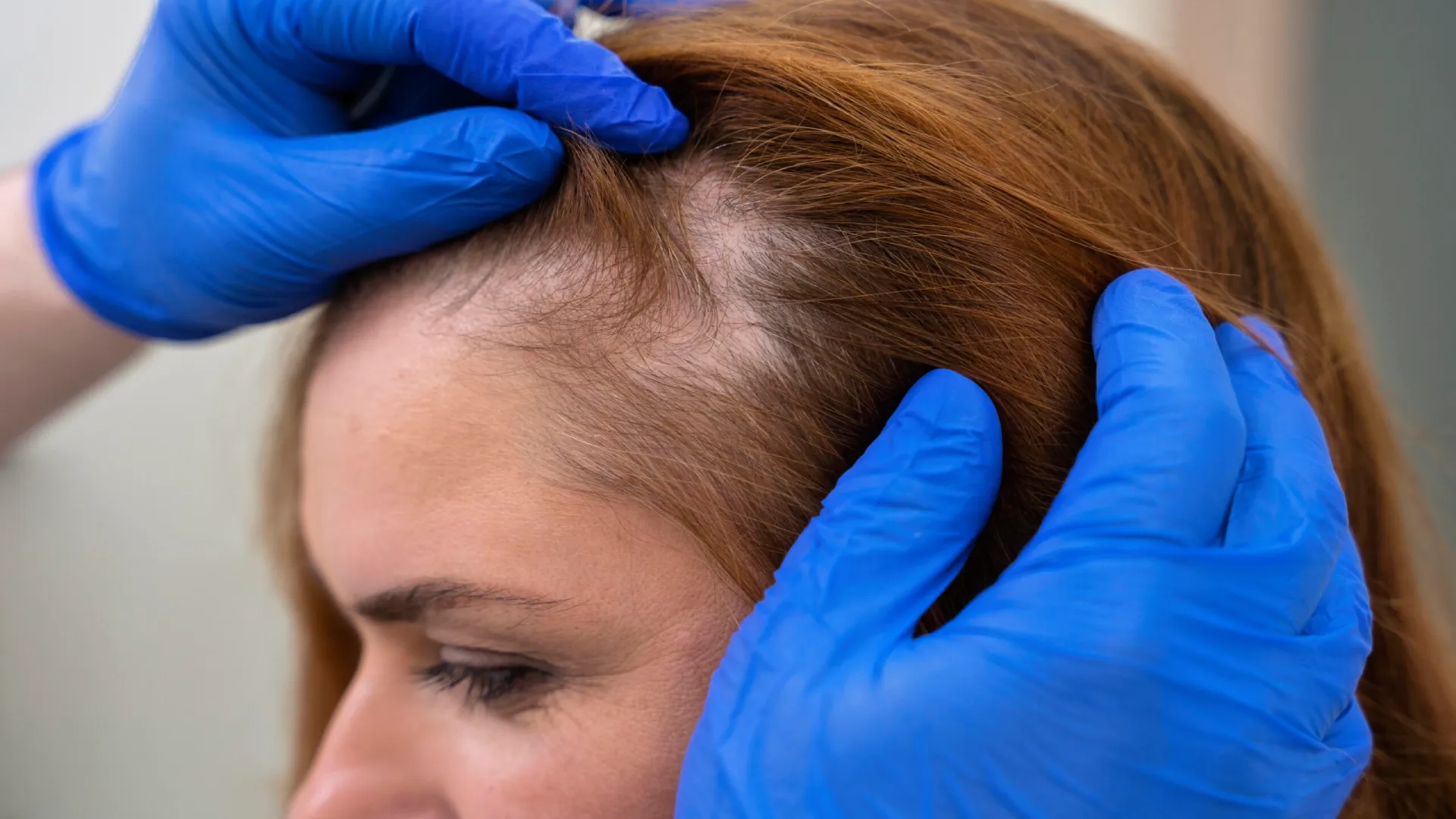 Understand Alopecia Areata and its causes, recognise symptoms and learn about effective treatment options.