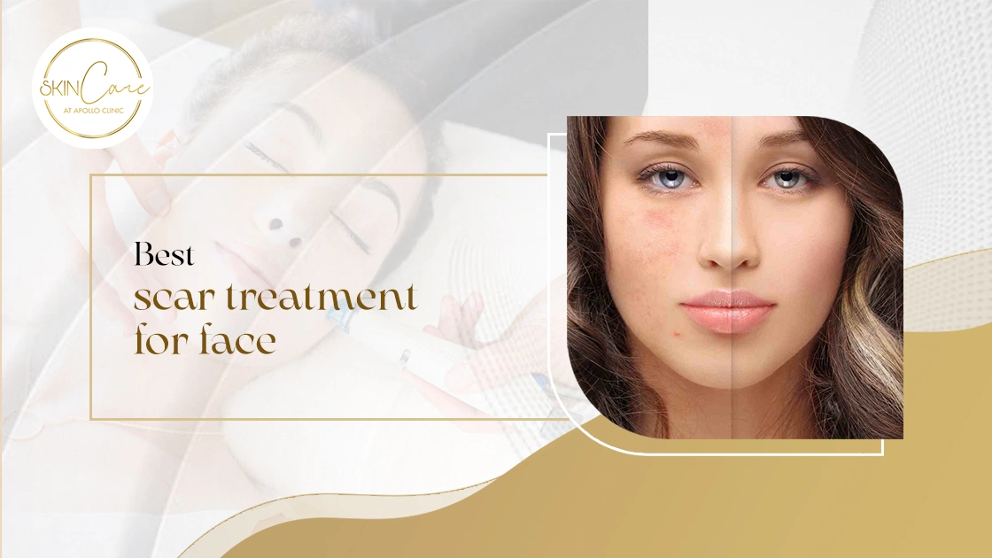 Best Scar Treatment for face