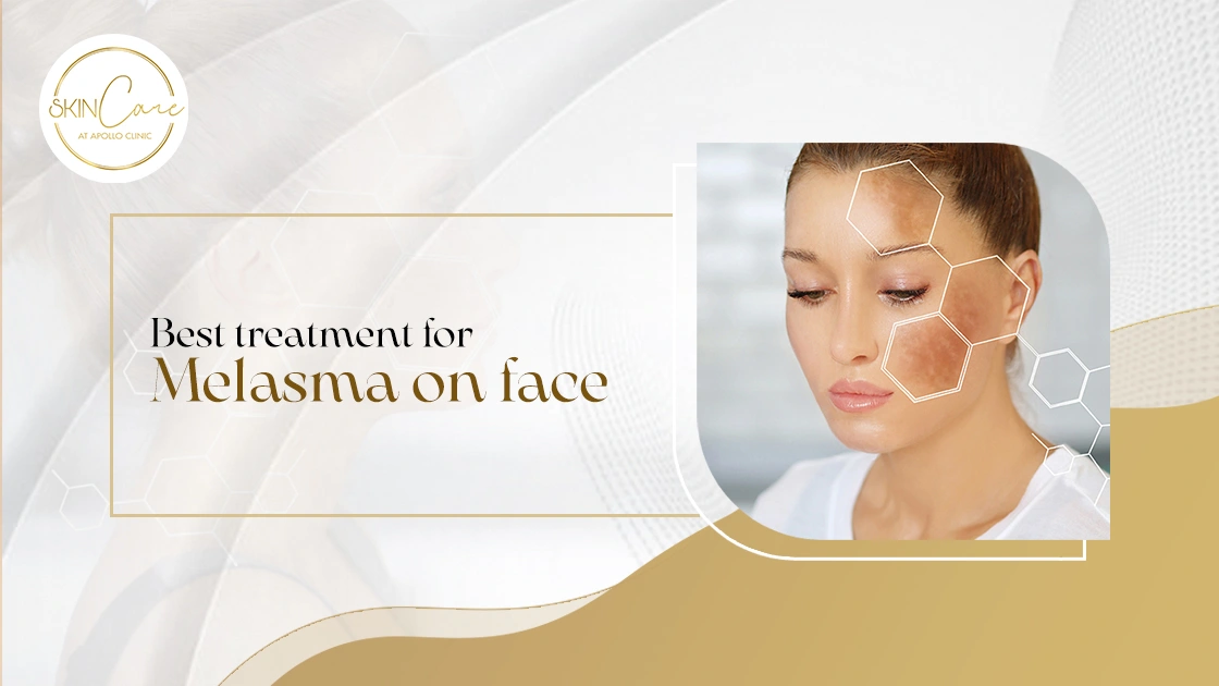 Best treatment for melasma on Face