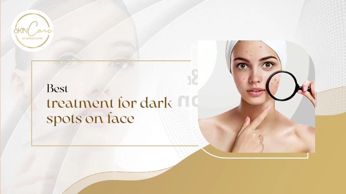 Best treatment for dark spots on face