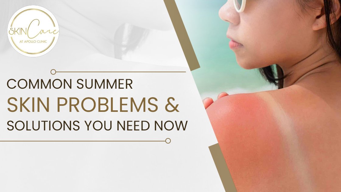 Beat summer skin troubles with dermatologist-backed advice. Find easy remedies for sunburn, breakouts, and dullness to keep your skin flawless.