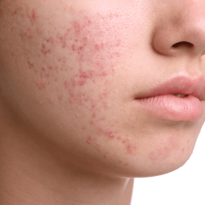 Acne & Acne Scars