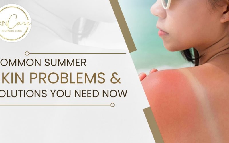 Beat summer skin troubles with dermatologist-backed advice. Find easy remedies for sunburn, breakouts, and dullness to keep your skin flawless.