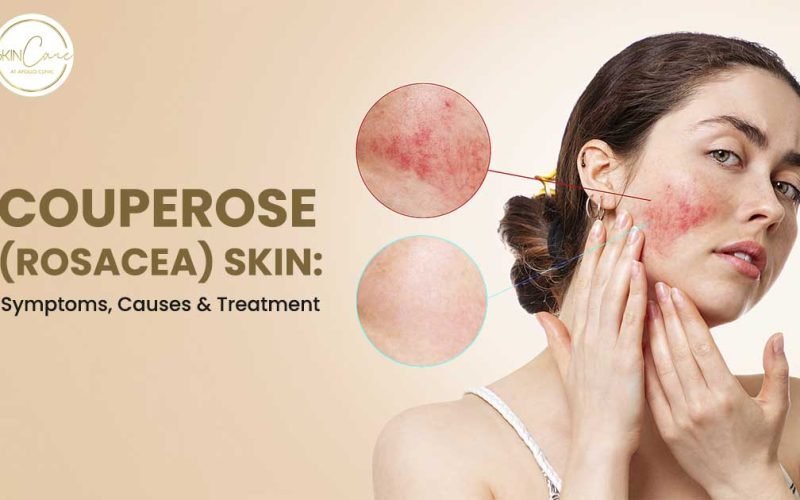 Couperose skin explained! Explore rosacea symptoms, triggers & the best treatments to calm irritation & achieve a more even skin tone.