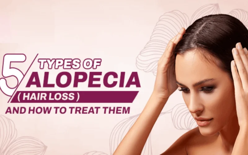 Discover the 5 common types of alopecia, their causes, and hair loss solutions.