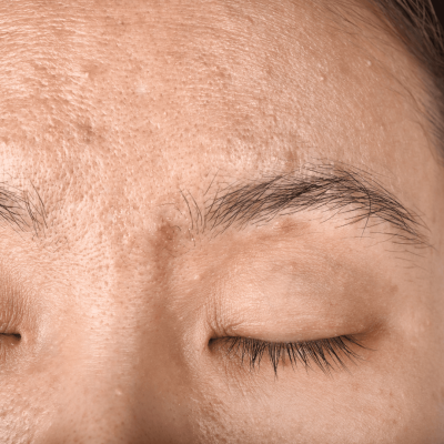 Visible Pores